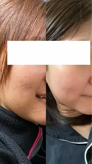 ≪ニキビケア≫ 素肌キレイLab.のエステ・リラクイメージ