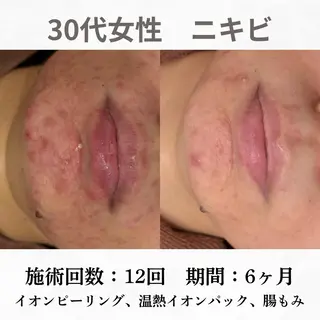 重度ニキビ専門🌷 ダウンタイムなしのエステ・リラクイメージ
