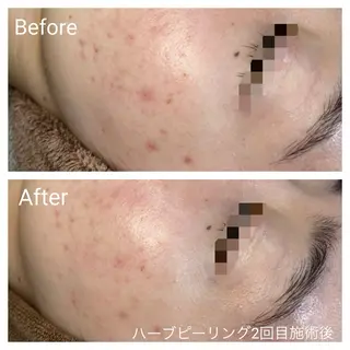 深い肌悩み&早期脱毛 完了サロンのエステ・リラクイメージ