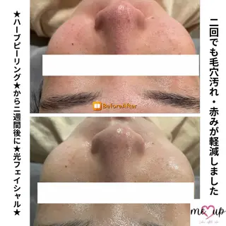 Meupニキビ専門店 背中/ハーブ/肌管理のその他イメージ