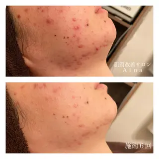 ミディアム カラー パーマ ヘアアレンジ メンズ キッズ ネイル マツエク・マツパ ニキビ跡専門サロン Ainaのエステ・リラクイメージ