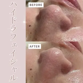 水素ハイドラ/脱毛 /ハーブピーリングのエステ・リラクイメージ