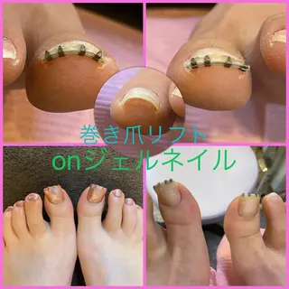 ネイル ♢ME2ROOM♢ #巻き爪#リラクのネイルデザイン