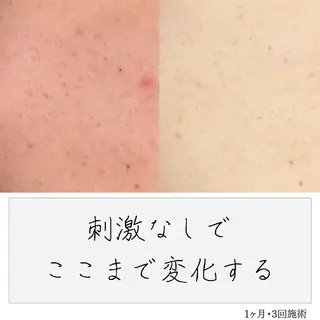 ニキビ経験者が施術 する専門サロン🌻のエステ・リラクイメージ