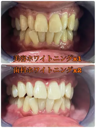東区香椎歯のセルフホ ワイトニングGLOWのその他イメージ