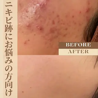 3か月で肌革命👼 ニキビ専門店💫のエステ・リラクイメージ