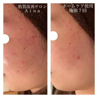 ミディアム カラー パーマ ヘアアレンジ メンズ キッズ ネイル マツエク・マツパ ニキビ跡専門サロン Ainaのエステ・リラクイメージ