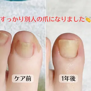 ネイル 巻き爪・肥厚爪ケア 専門サンセリテのネイルデザイン