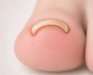 ネイル フットケア 巻き爪のネイルデザイン