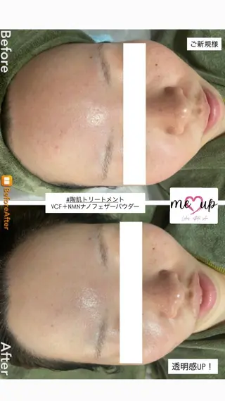 Meupニキビ専門店 背中/ハーブ/肌管理のその他イメージ