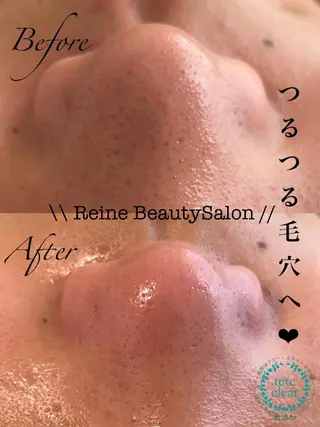 毛穴/シミ肝斑/脱毛 横山梨里のエステ・リラクイメージ