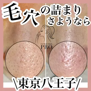 毛穴特化エステ -リールのエステ・リラクイメージ