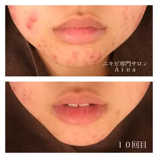 ミディアム カラー パーマ ヘアアレンジ メンズ キッズ ネイル マツエク・マツパ ニキビ跡専門サロン Ainaのエステ・リラクイメージ