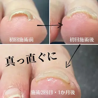 ネイル 巻き爪・肥厚爪ケア 専門サンセリテのネイルデザイン