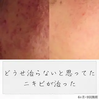 ニキビ経験者が施術 する専門サロン🌻のエステ・リラクイメージ