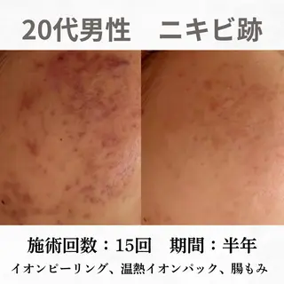 重度ニキビ専門🌼 ダウンタイムなしのエステ・リラクイメージ