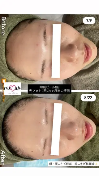 Meupニキビ専門店 背中/ハーブ/肌管理のその他イメージ