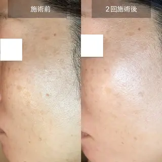 メンズ 小顔とシミケア🪽 /Salon Mのエステ・リラクイメージ