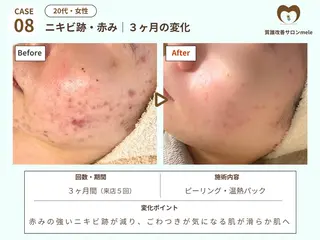 ニキビケア・毛穴専門 mele|もりぞののエステ・リラクイメージ