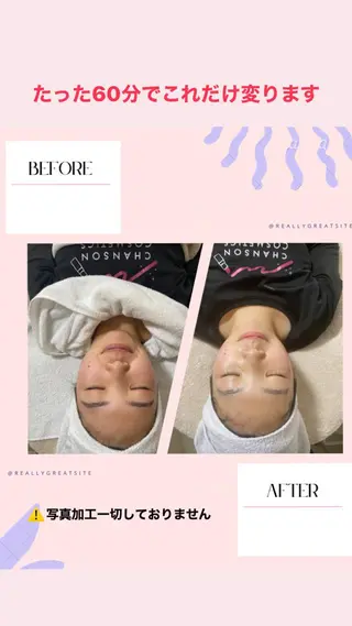 肌質改善 CEサロンRavirのエステ・リラクイメージ