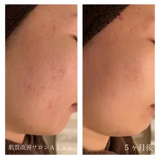 ロング カラー パーマ ヘアアレンジ メンズ キッズ ネイル マツエク・マツパ ニキビ跡専門サロン Ainaのエステ・リラクイメージ