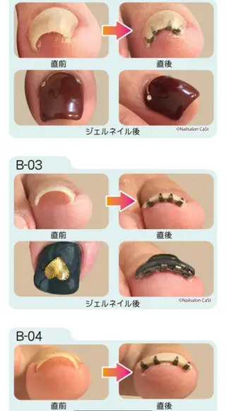 ネイル ♢ME2ROOM♢ #巻き爪#リラクのネイルデザイン