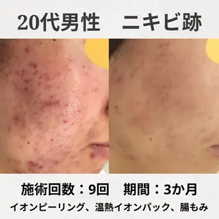 繰り返すニキビ跡専門 根本改善のエステ・リラクイメージ