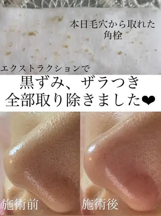 毛穴/シミ肝斑/脱毛 横山梨里のエステ・リラクイメージ