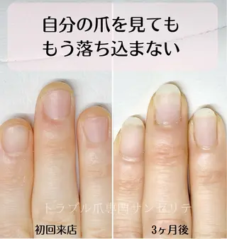 ネイル 深爪・巻き爪 専門サンセリテのネイルデザイン