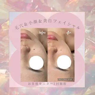🌷MURA 毛穴・顔脱毛🌷のエステ・リラクイメージ