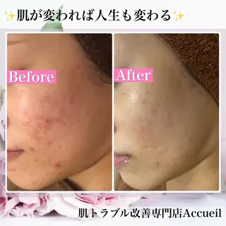ミディアム カラー パーマ ヘアアレンジ メンズ キッズ ネイル マツエク・マツパ アイブロウ ニキビ・肌質改善専門 ♡人生が変わるサロンのエステ・リラクイメージ