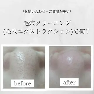 毛穴ケア・肌質改善 徳川のエステ・リラクイメージ