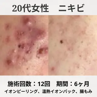 何をしても繰り返す ニキビ・ニキビ跡専門のエステ・リラクイメージ