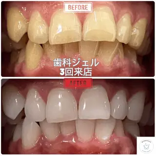 東区香椎歯のセルフホ ワイトニングGLOWのその他イメージ
