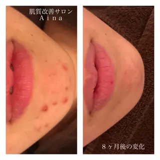 セミロング パーマ ヘアアレンジ キッズ ネイル マツエク・マツパ ニキビ跡専門サロン Ainaのエステ・リラクイメージ