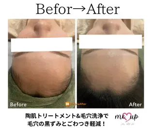 Meupニキビ専門店 背中/ハーブ/肌管理のその他イメージ
