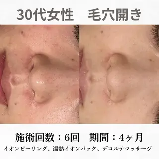 重度ニキビ専門🌷 ダウンタイムなしのエステ・リラクイメージ