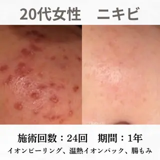 重度ニキビ専門🌼 ダウンタイムなしのエステ・リラクイメージ