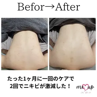 Meupニキビ専門店 背中/ハーブ/肌管理のその他イメージ