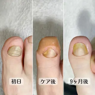 ネイル 巻き爪・肥厚爪ケア 専門サンセリテのネイルデザイン