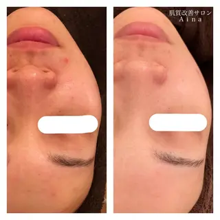 セミロング パーマ ヘアアレンジ キッズ ネイル マツエク・マツパ ニキビ跡専門サロン Ainaのエステ・リラクイメージ