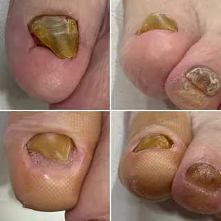 ネイル 巻爪無料モデル募集 ✨🦶MEGUMIのネイルデザイン