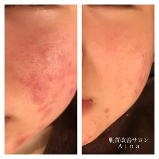 セミロング カラー パーマ ヘアアレンジ メンズ キッズ ネイル マツエク・マツパ ニキビ跡専門サロン Ainaのエステ・リラクイメージ