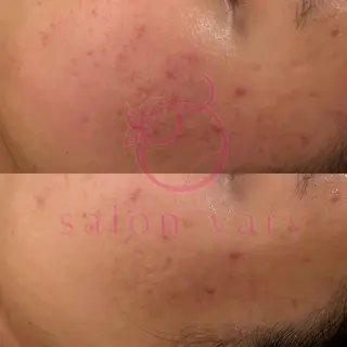 ニキビ•ニキビ跡改善 salon varyのエステ・リラクイメージ