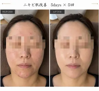 藤沢ハーブピーリング 肌質改善senangのエステ・リラクイメージ
