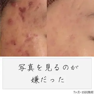 ニキビ経験者が施術 する専門サロン🌻のエステ・リラクイメージ