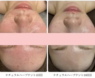 ハーブ蒸しハーブピー リング🪻香嬉琉きよのエステ・リラクイメージ