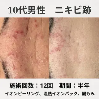 何をしても繰り返す ニキビ・ニキビ跡専門のエステ・リラクイメージ