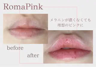 たるみほうれい線ケア 看護師サロンのエステ・リラクイメージ