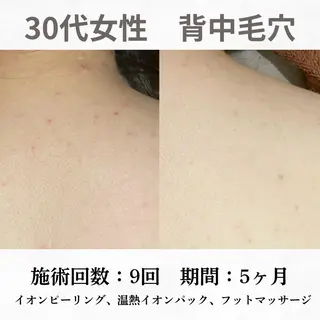 重度ニキビ専門🌼 ダウンタイムなしのエステ・リラクイメージ